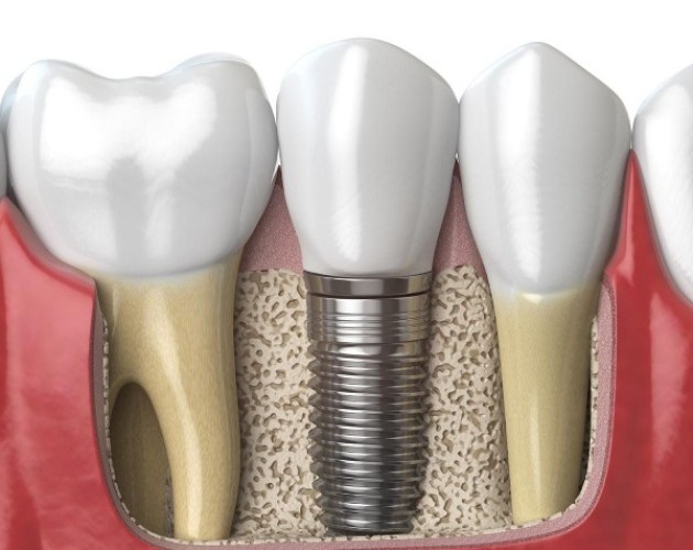 Implante dental